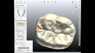 Fast 5 Minute Crown Design with 3Shape [upl. by Maddocks]