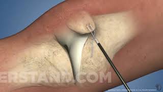 Cirurgia do Ligamento Patelofemoral medial [upl. by Eirised]