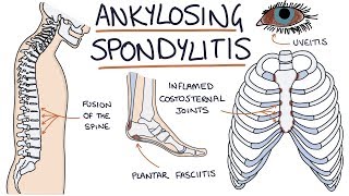 Ankylosing Spondylitis Visual Explanation for Students [upl. by Romulus]