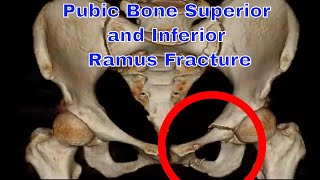 치골 상하지 골절 원인 증상 치료 Fractured Pubic Rami Causes amp Treatment [upl. by Anadroj67]