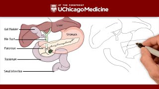 What is the Whipple procedure  UChicago Medicine [upl. by Autry]