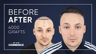 Excellent Before amp After Hair Transplant with Dr Acar [upl. by Kesia]