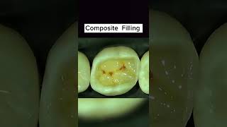 Composite Restoration Light cure restorationclass 2 composite Restoration [upl. by Anirak]