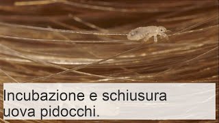 Periodo di incubazione e trattamento della pediculosi umana durata e cure per i pidocchi [upl. by Arakihc]