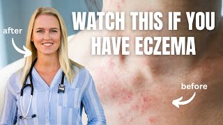 DO this ONE thing to heal your ECZEMA for Good  Eczema Treatment Naturally [upl. by Ettesus]