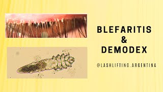 Blefaritis y Demodex liftingdepestañas lashlifting [upl. by Amek223]