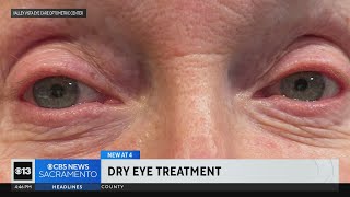 Recenly approved FDA technique proving good treatment for dry eyes [upl. by Yzus344]