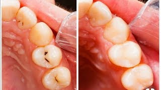 how to get rid of cavities and tooth decay fast [upl. by Ahseken]