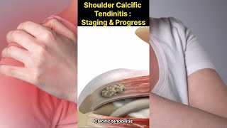 Shoulder Calcific Tendinitis  Progress and Staging [upl. by Nirej797]