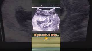 Medical Education  Pelvic Ultrasound of Fetus [upl. by Malo369]