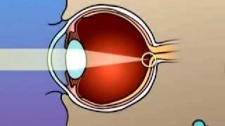 PreOp® Patient Education Lasik Laser Eye Surgery [upl. by Benni994]