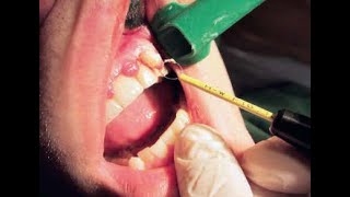 Gingivectomy hf surg [upl. by Aitnahc]