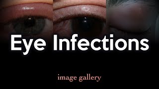 Eye Infections Image Gallery [upl. by Sol]