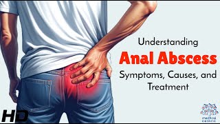 Anal Abscess Explained From Symptoms to Treatment Options [upl. by Udell652]