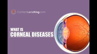 Corneal Diseases of the Eye  Keratoconus Fuchs Endothelial Dystrophy Bullous Keratopathy [upl. by Kronick]