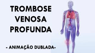 TROMBOSE VENOSA PROFUNDA TVP  Sintomas e Fatores de Risco Animação Dublada [upl. by Eedna683]