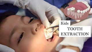 Primary Tooth Extraction  why not to be afraid of the dentist [upl. by Vanna699]