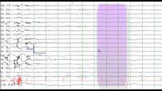 EEG Reading Rounds EEG in Frontal Lobe Epilepsy [upl. by Iruj780]