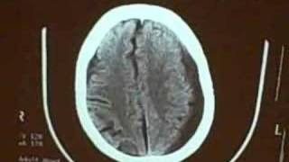 Subdural hematoma [upl. by Daven]