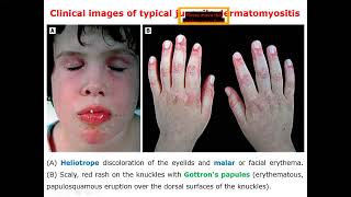 Jevunile Dermatomyositis Rheumatology [upl. by Pirzada]