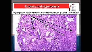 PATHOLOGY PRACTICAL  ENDOMETRIAL  BENIGN PROSTATIC HYPERPLASIA  NODULAR GOITER AND METAPLASIA [upl. by Ardell]