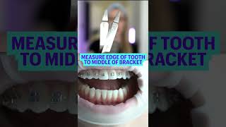 How Braces Are Put On  Braces Colors [upl. by Nichola]