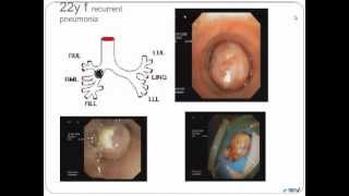 Bronchoscopy Management of Complications [upl. by Petersen]