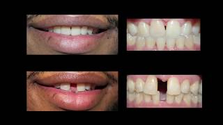 Invisaign for Teeth Gap Treatment at Cosmetic Dental Associates [upl. by Zorine517]