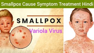 Smallpox Variola Cause Symptoms Diagnosis Treatment in Hindi  Smallpox Hindi  What is Smallpox [upl. by Trow]