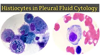 Histiocytes in Pleural Fluid for Cytology  Pleural Fluid Routine Examination [upl. by Atikin]