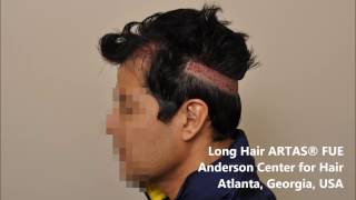 The ARTAS Robotic Hair Restoration Procedure [upl. by Celtic]