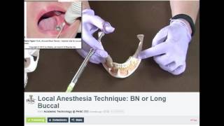 Long Buccal Dental Anesthesia Technique [upl. by Intruoc959]