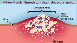 What is MRSA Methicillin Resistant Staphylococcus Aureus [upl. by Ennyrb184]