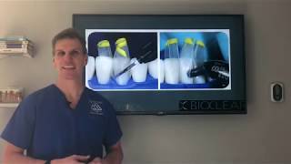 The best and easiest solution to closing tooth gaps Bioclear  Black triangles in teeth [upl. by Yeffej]