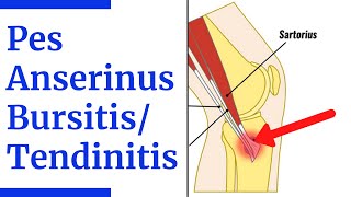 Pes Anserine BursitisTendinitis Evaluation [upl. by Chiarra312]