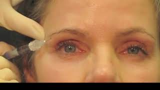 Filler Technique for Rejuvenation of the Upper Periocular Area [upl. by Gamages]