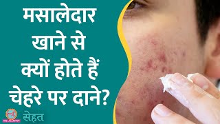 चेहरे पर Acne Pimples से परेशान हैं कहीं आप Spicy Food तो नहीं खाते Sehat Ep 852 [upl. by Idurt537]