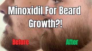 1 Year of Using Minoxidil For Beard Growth  Minoxidil for Beard Before and After [upl. by Haden]