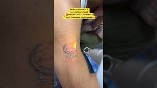 Lasertattooremoval Hyderabad ☎️9951066724 amp 7386896855 luckytattoostudio lasertattooremoval ink [upl. by Scherman]