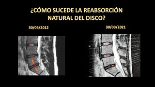 HERNIA DISCAL L5 S1  RECUPERA TU VIDA NORMAL REABSORCIÓN NATURAL DEL DISCO EXPLICADA EN DETALLE [upl. by Ashlen]