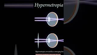 myopia nearsightedness [upl. by Eilrac]