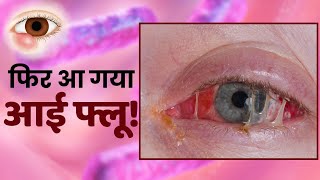 Eye Flu Preventions आई फ्लू से बचने का ये है आसान तरीका  Conjunctivitis [upl. by Eseilenna]