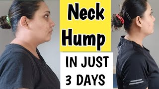 NECK HUMP NECK FAT BUFFALO HUMP  3 DAYS CHALLENGE TO REDUCE NECK HUMP FAT UPPER NECK FAT [upl. by Behl86]