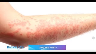 HIVES Symptoms and Treatment [upl. by Eob82]