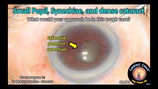 CataractCoach™ 1879 small pupil synechiae and dense cataract [upl. by Adnohsat]