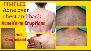 Pimples on chest and back or Acneiform Eruptions aka Drug induced acne  with Teratogenic Drugs [upl. by Niassuh630]