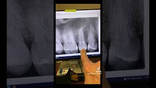 Root canal therapy of tooth 4 [upl. by Tatia]