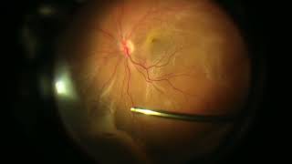 Dancing Retina and Sub Retinal Fluid Drainage in Bullous Retinal Detachment by Prof Amer Awan [upl. by Flieger]