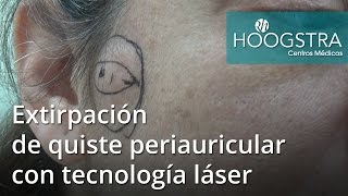 Extirpación de quiste periauricular con tecnología láser 16125 [upl. by Sanfourd105]