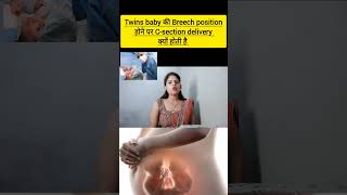 twins baby ki breech position hone par c section delivery kyu krani chahiye twins baby ki delivery [upl. by Lekcar]